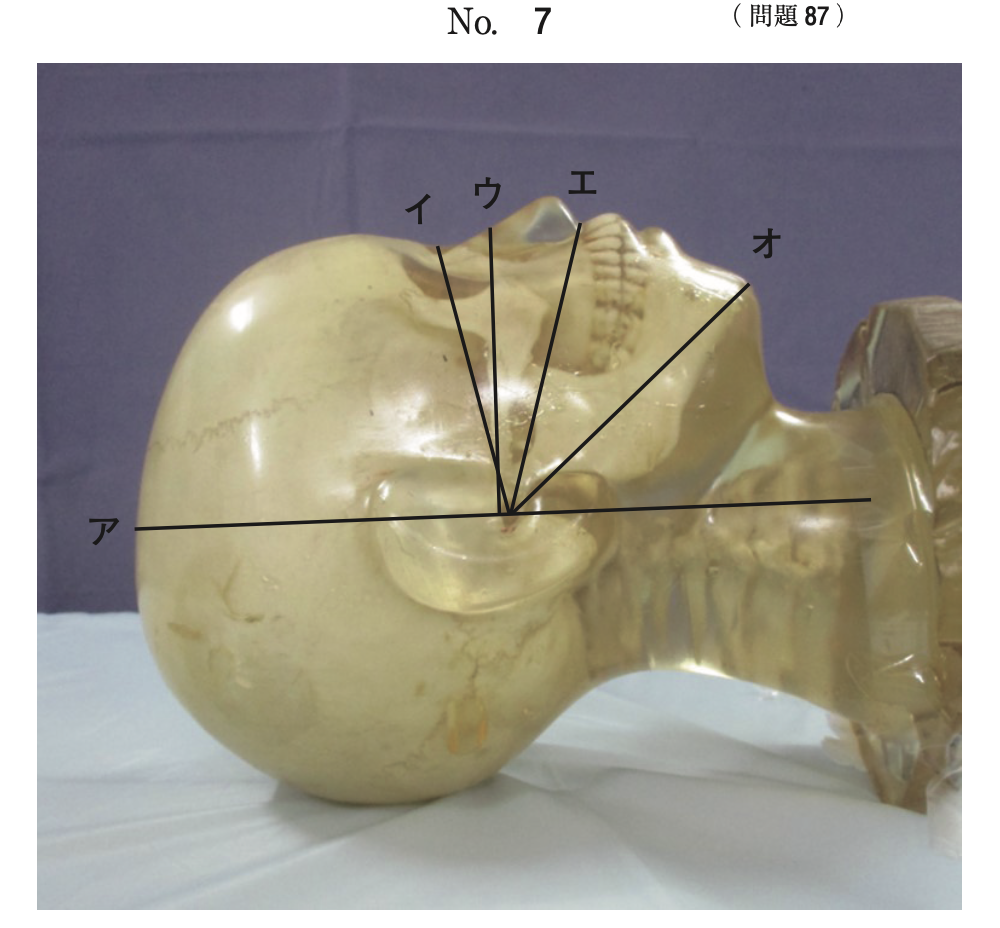 問87の頭部撮影基準線の図(出典:厚生労働省)